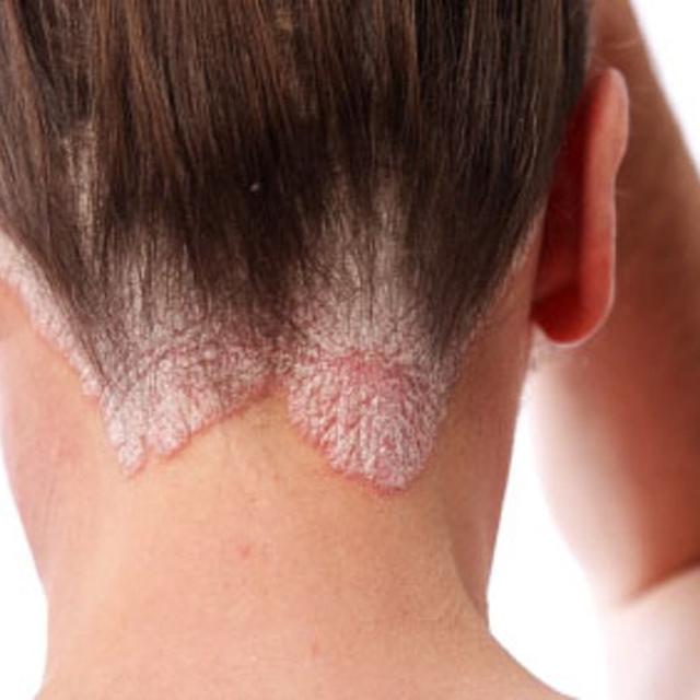 Mengenal Psoriasis Penyakit Yang Dialami Istri Caisar Yks Health Liputan6 Com