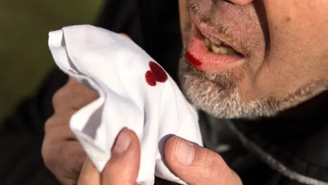 Jangan Anggap Remeh Batuk Berdarah!