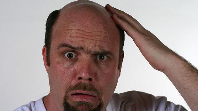 Ilmuwan Klaim Sudah Temukan Obat Kebotakan