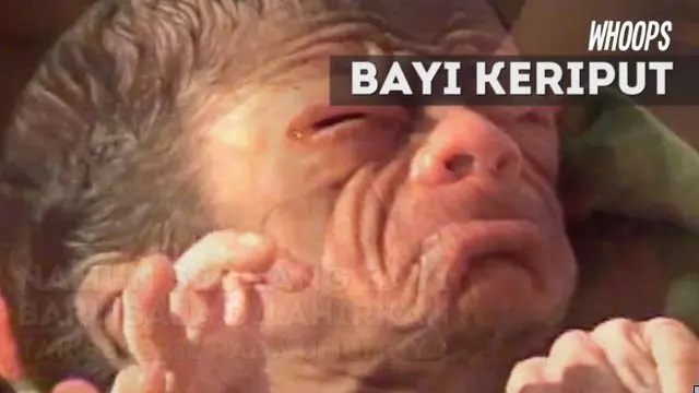 WHOOPS: Miris, Bayi Baru Lahir ini Berwajah Keriput Seperti Kakek-Kakek