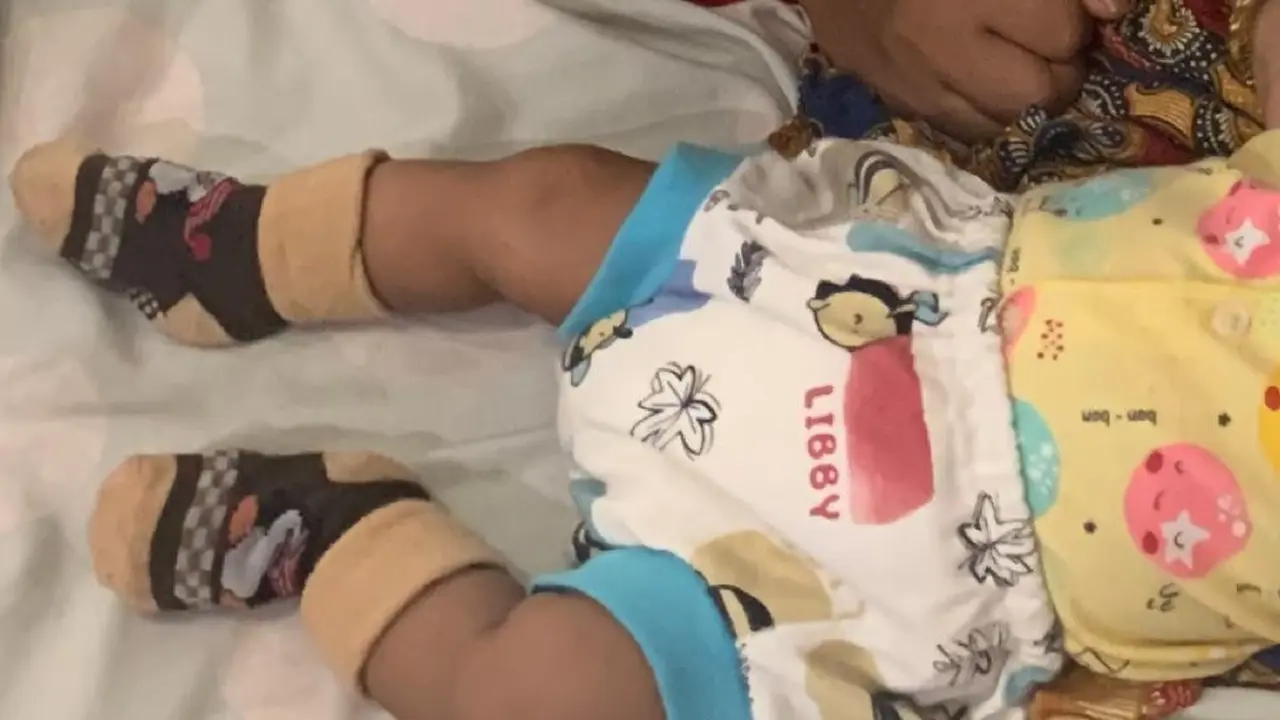 Hemangomia di dekat mata bayi. (Foto: Liputan6.com/Dok. RSI Banjarnegara)