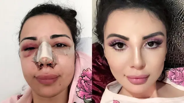 [Bintang] Operasi Plastik