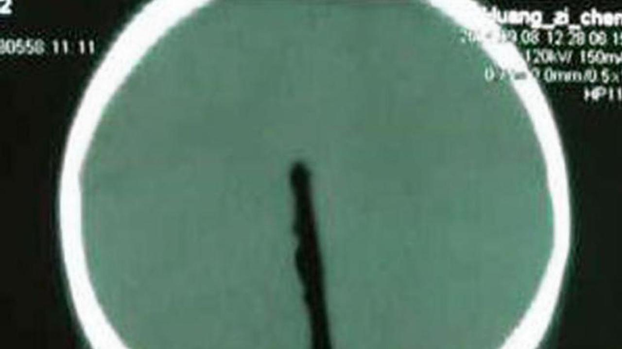 Ngeri, Sumpit Kayu Nyaris Tembus Otak Bocah China Ini