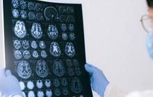 Bahaya Serangan Pasca-Stroke, Komplikasi Mematikan yang Perlu Diwaspadai