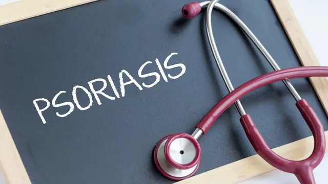 Penyakit Psoriasis (Sumber: iStockphoto)