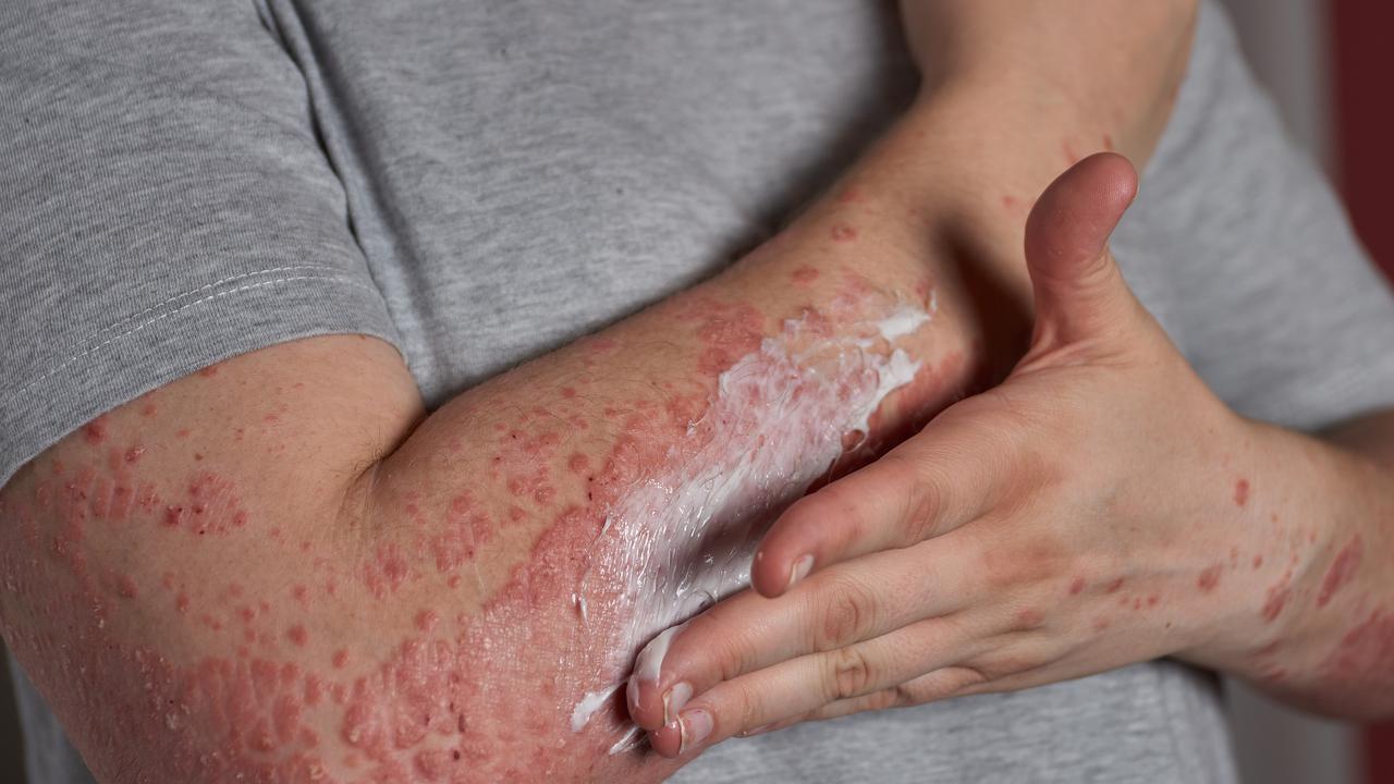 Apa Itu Lupus? Dari Jenis-jenis Hingga Pengobatan yang Harus Anda Ketahui!