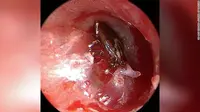 Kutu yang menempel pada liang telingan bocah di Connecticut, Amerika Serikat. (www.nejm.org)