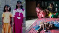 Seperti Hanoman, Bulu Tumbuh Lebat di Sekujur Tubuh Bayi Ini