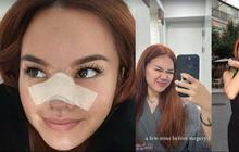 Potret Shafa Harris Oplas Hidung di Korea Selatan, Ambil Tulang dari Iga dan Wajah Minim Bengkak