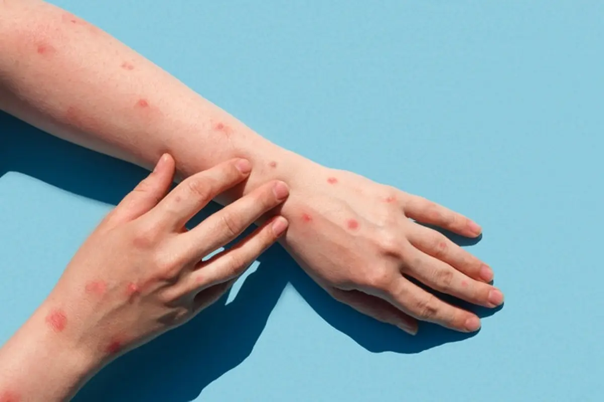 Tips Menjaga Kesehatan Kulit Bila Terserang Monkeypox
