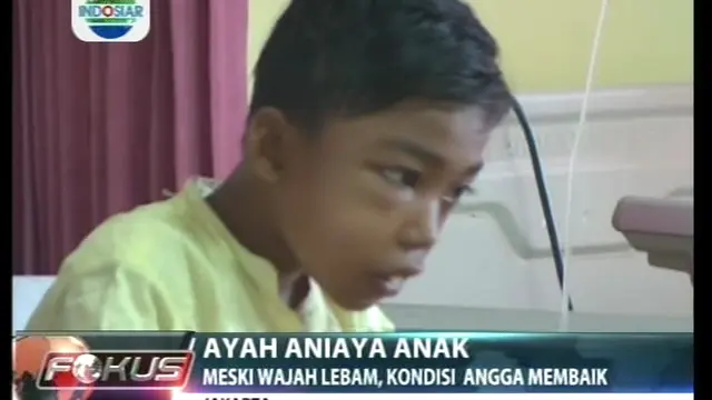 Ayah Aniaya Anak, Meski Wajah Lebam, Kondisi Angga Membaik