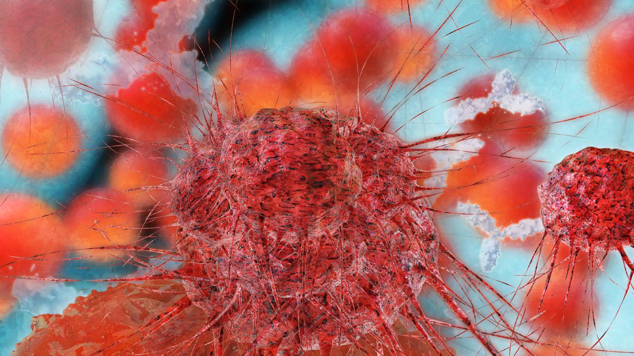 Ilustrasi Kanker Payudara