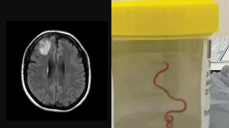 Cacing Ditemukan Hidup Di Otak Manusia