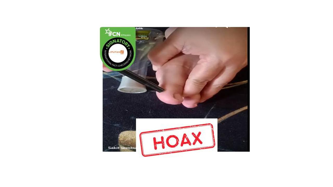 Cek fakta pijat jempol kaki sembuhkan sakit gigi