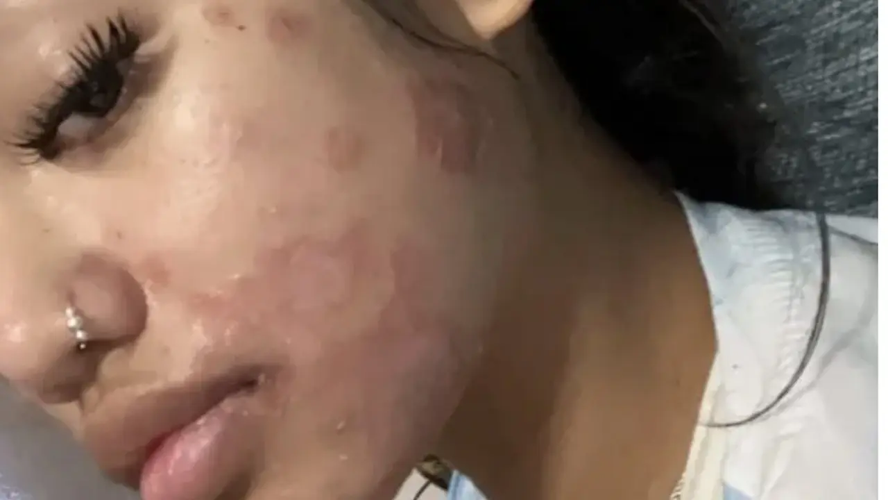 Kulit terkena jamur