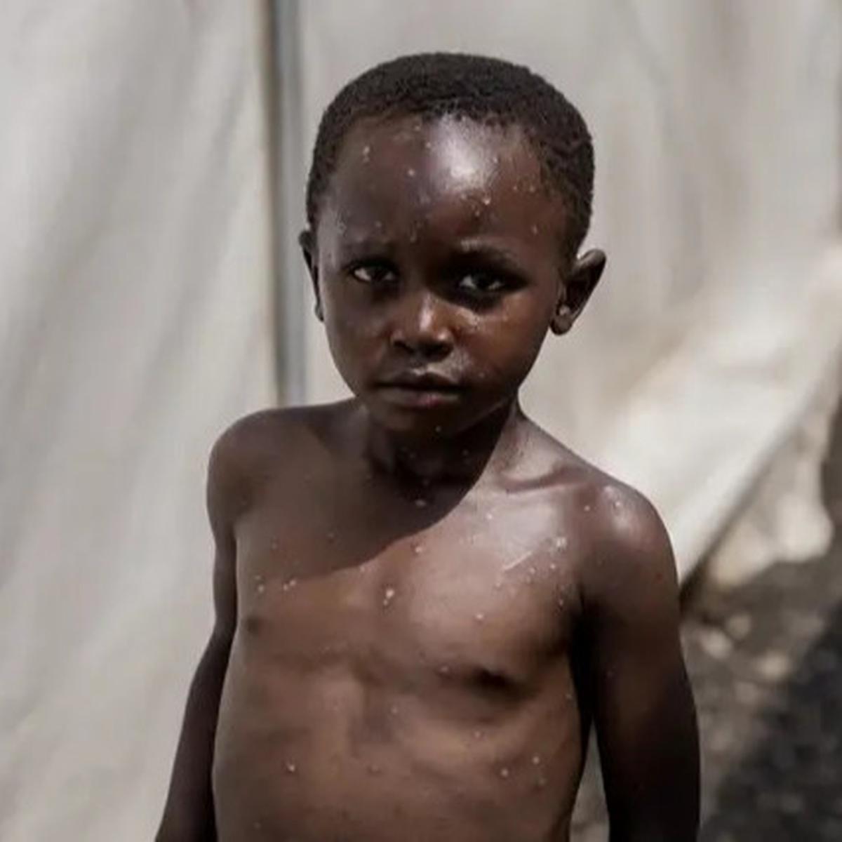 Mpox Bakal Jadi Ancaman Global Baru? Kenali Gejala, Penularan, dan Upaya Pencegahannya