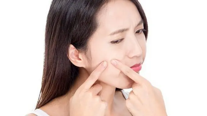 Kulit berjerawat butuh perawatan khusus/copyright: thinkstockphotos.com