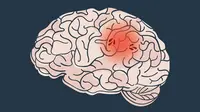 5 Cara Efektif Kurangi Risiko Stroke, Praktikkan Gaya Hidup Sehat Berikut Ini