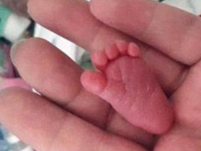 Bayi Paling Mungil Di Dunia Beratnya Cuma 0 2 Kilogram Citizen6 Liputan6 Com