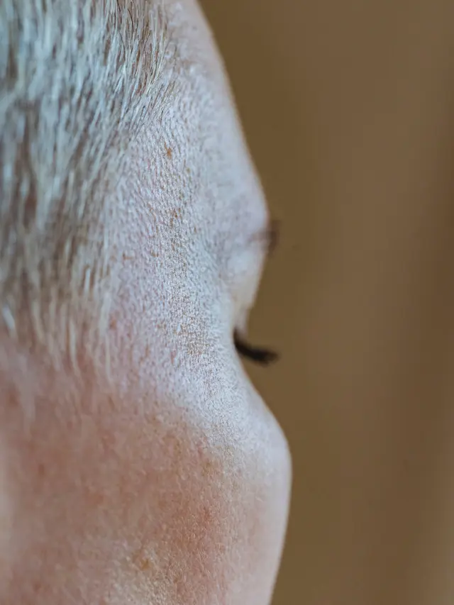 Contoh ilustrasi brown spot pada kulit