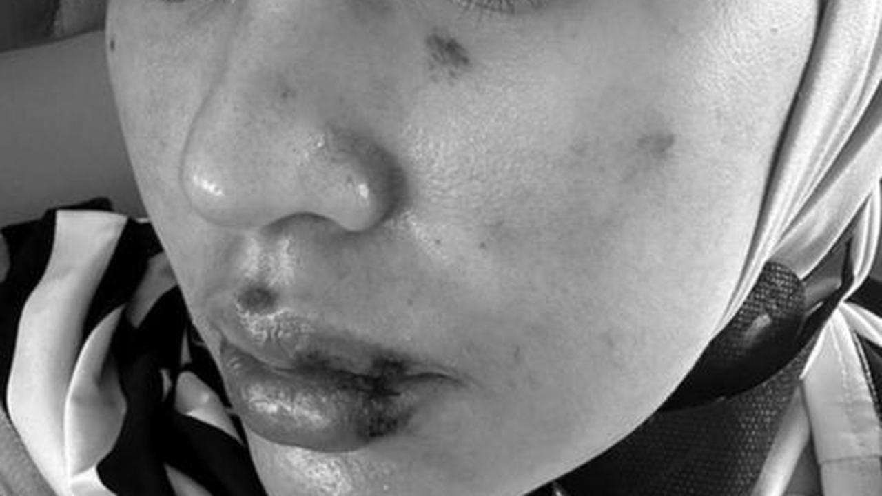 Kartika Putri Sakit Misterius, Wajah dan Lidahnya Melepuh! Berikut Kabarnya