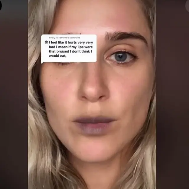 Seorang perempuan di Inggris sedang menjalani filler
