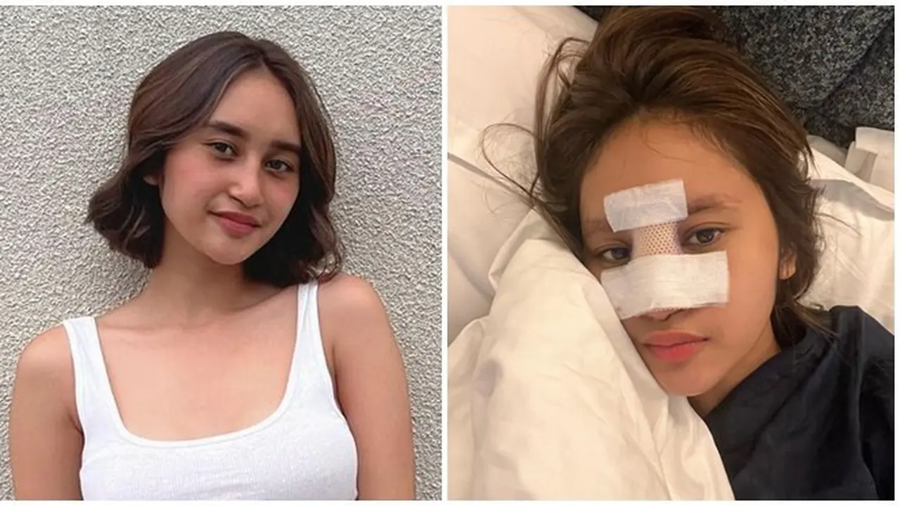 12 Foto Kronologi Dhyaz Anak Farida Nurhan Alami Infeksi Hidung hingga Angkat Implan