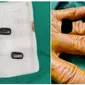 Tangan pasien yang di operasi untuk mengeluarkan magnet di dalamnya (Tangkapan layar dari website odditycentral.com)