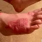 Michael terinfeksi cacing tambang usai menimbun tubuhnya di pasir pantai. (Facebook Kelli Mulholen Dumas)