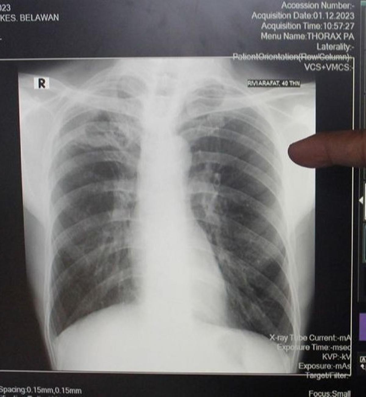 Indonesia Rekrut 2.095 Partisipan Uji Klinik Vaksin TBC M72: Harapan Baru Pemberantasan Tuberkulosis