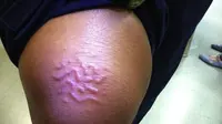 Cacing bersarang di dalam kulit seorang perempuan setelah ia berlibur ke Karibia (Elsevier Inc. 2017)
