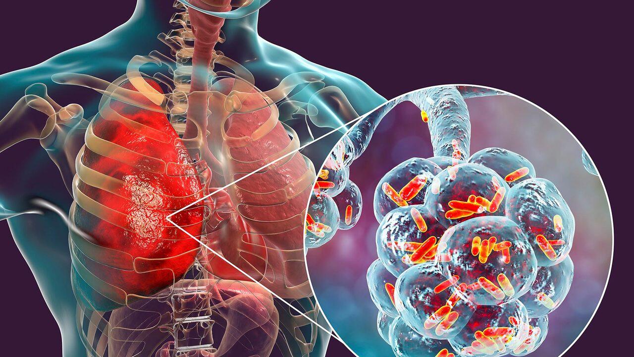 Legionnaires' Disease Outbreak Hits New York City: Dozens Ill, Three Dead