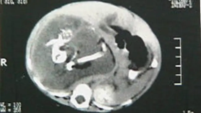 Kondisi langka fetus in fetu. (Sumber Wikimedia Commons)