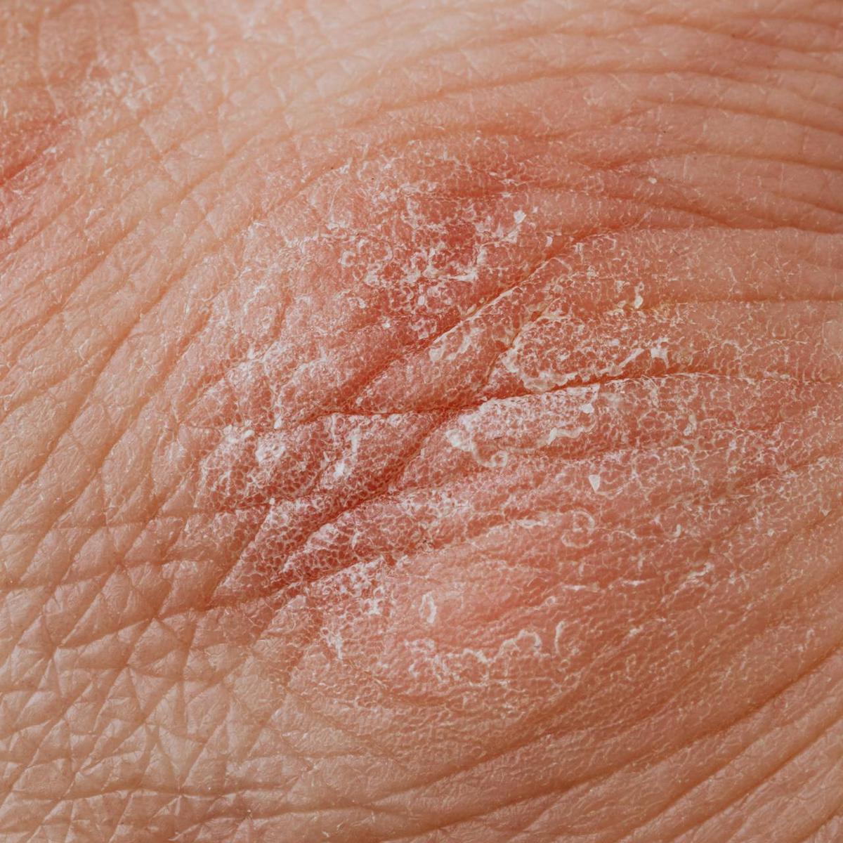 Ilustrasi Dermatitis Kontak