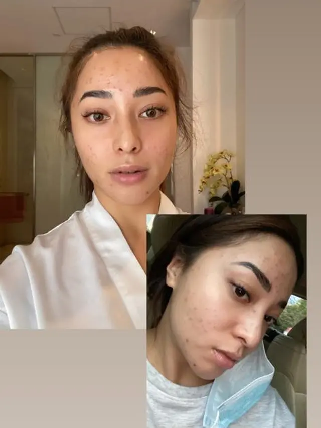 Unggah Foto Berjerawat, Ini 6 Potret Nikita Willy Tampil Natural
