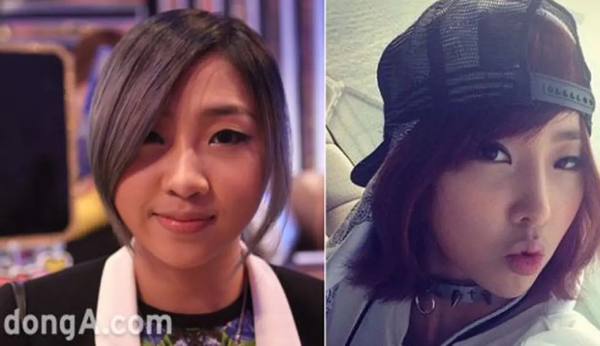 Minzy 2NE1 mengaku pada tahun 2013 melalui YG Entertainment yang merupakan agensinya, jika ia melakukan operasi hidung untuk menyembuhkan rhinitisnya. (via dramafever.com)