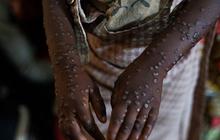 FOTO: Lonjakan Varian Baru Mpox atau Cacar Monyet Meluas, Penyebaran Virus Sudah ke Asia dan Eropa