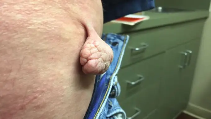 Mirip Otak, Daging Tumbuh Pada Pria Ini Akhirnya Dioperasi