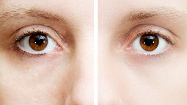 10 Manfaat Temulawak untuk Kecantikan, Bantu Atasi Jerawat Hingga Cerahkan Kulit