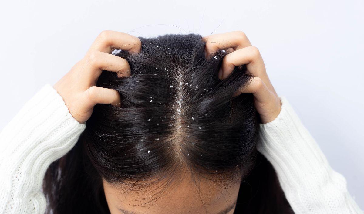 Kaitan Ketombe dengan Rambut Rontok