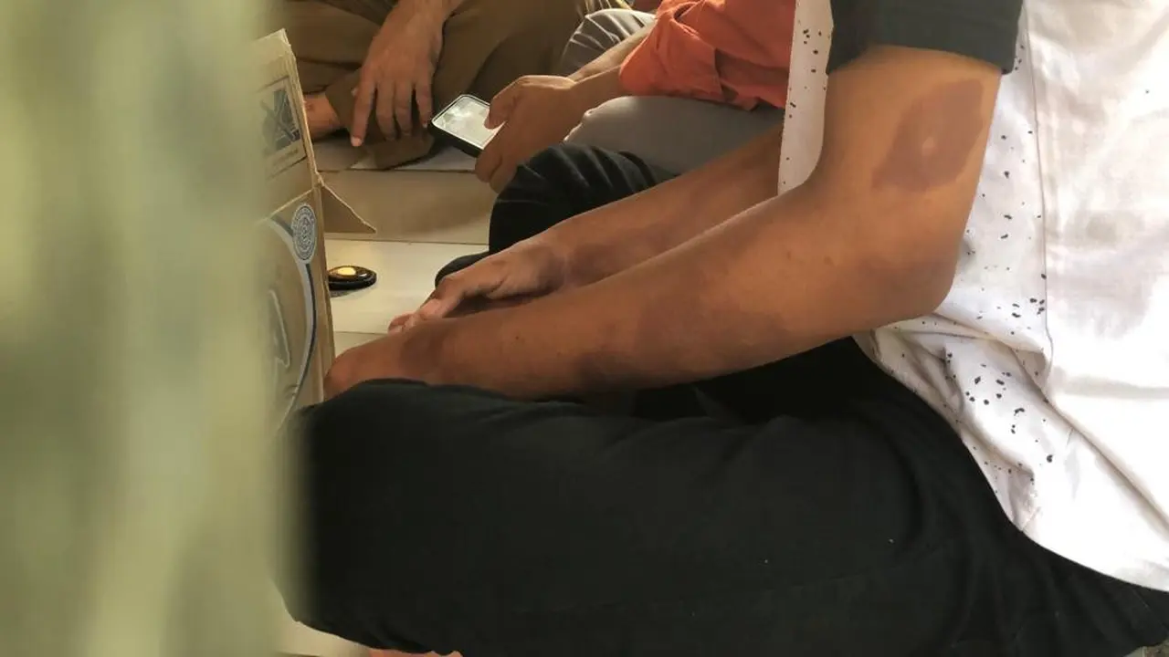Penyandang kusta di Indramayu