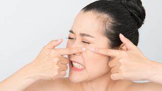 Ilustrasi jerawat/copyright shutterstock