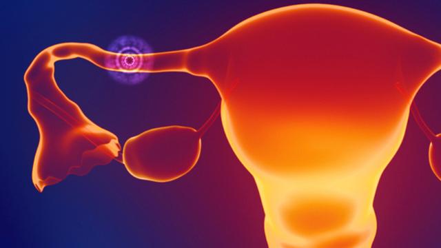 [Seri Kehamilan] Apa Itu Kehamilan Ektopik di Trimester Pertama?