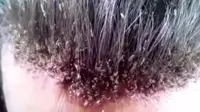 Ratusan Kutu Rambut Bersarang di Kepala Pria Ini