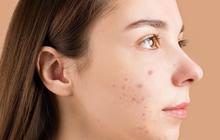 5 Ciri-ciri Skincare Tidak Cocok di Kulit yang Jarang Disadari, Kenali Tandanya