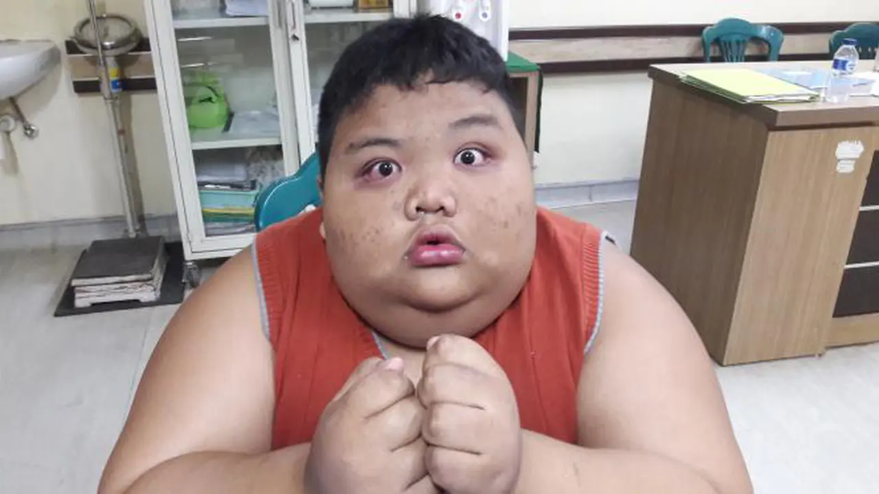 Top 3: Membaik, Rizki Bocah Obesitas Bisa Duduk dan Makan Pisang