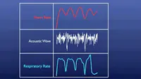 Suara detak jantung dan irama pernafasan yang dipancarkan oleh stetoskop yang ditelan. (Sumber cuplikan video MIT)