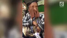 Kulit wajah nenek berusia 63 tahun ini tampak seperti "meleleh". Wiang Boonmeen mengidap penyakit kulit langka.
