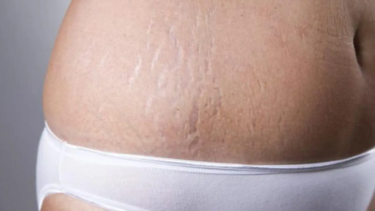 Strech Mark