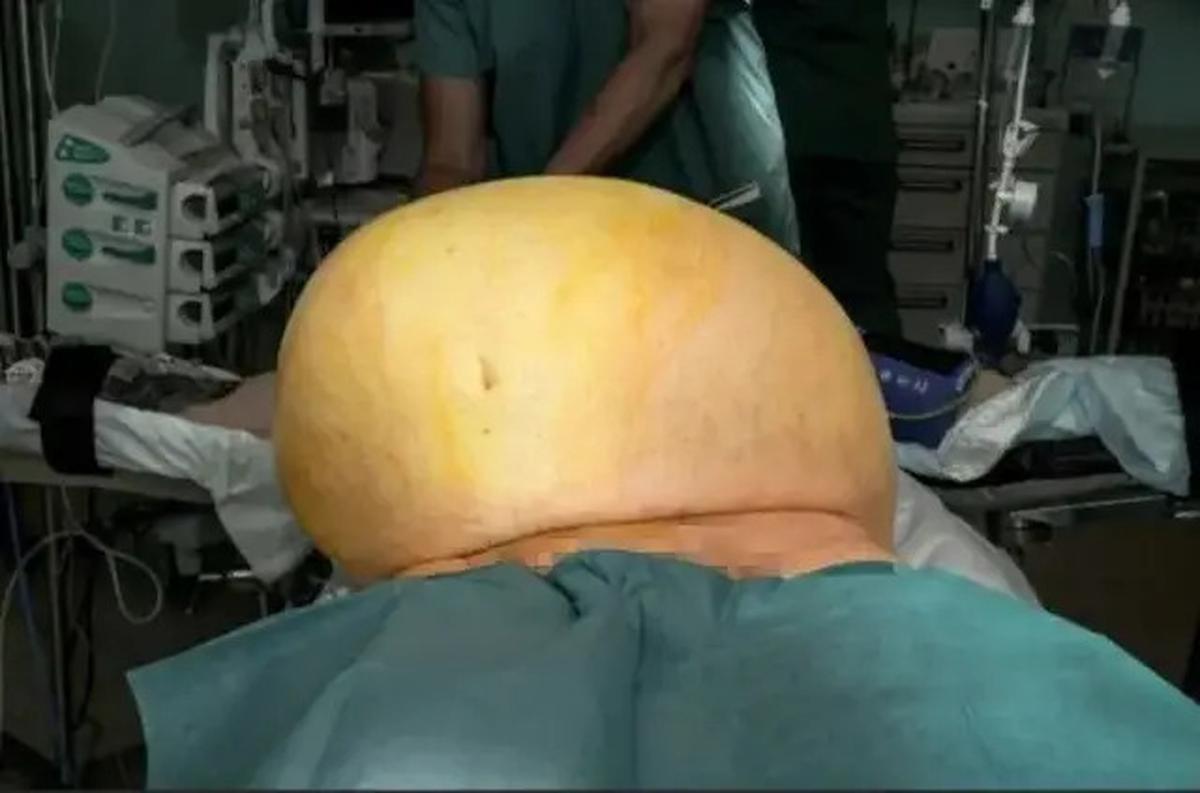 Dicap Gemuk, Pria Ini Ternyata Punya Tumor Seberat 27 Kg di Perut